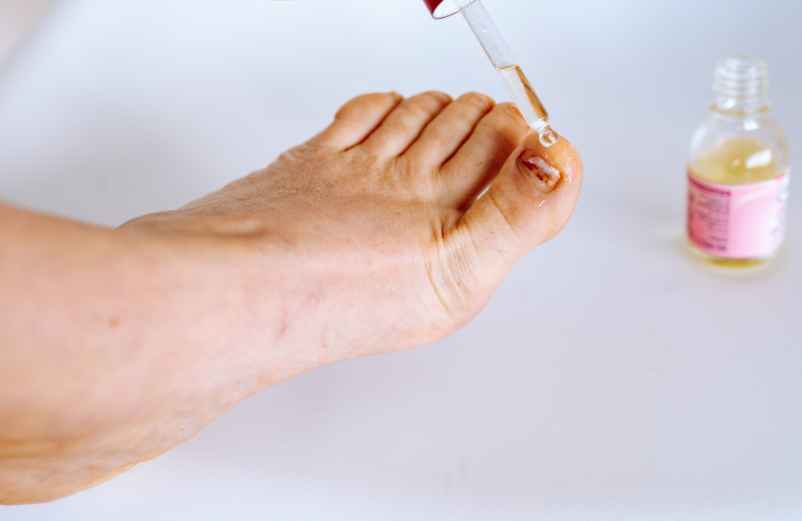 Mycose du pied : traitement rapide et précautions avec les huiles essentielles-Info Vaccins France